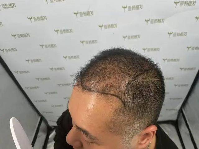 “还能反光<strong></p>
<p>固定收益理财产品</strong>！”长沙男子植发近9月称后脑勺“像狗啃过”