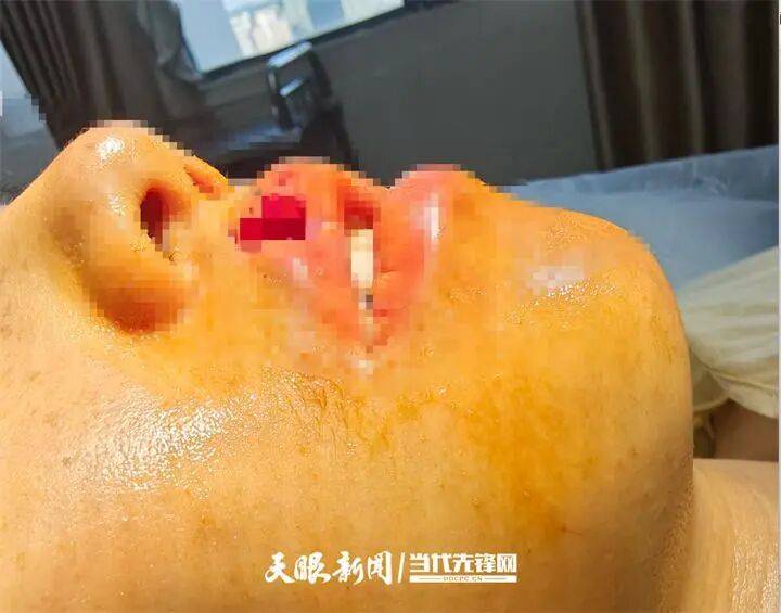 女子上门代喂被100多斤阿拉斯加犬咬伤毁容<strong></p>
<p>菠菜理财</strong>，牙槽骨和牙齿都被撕咬脱落，狗主人却称→