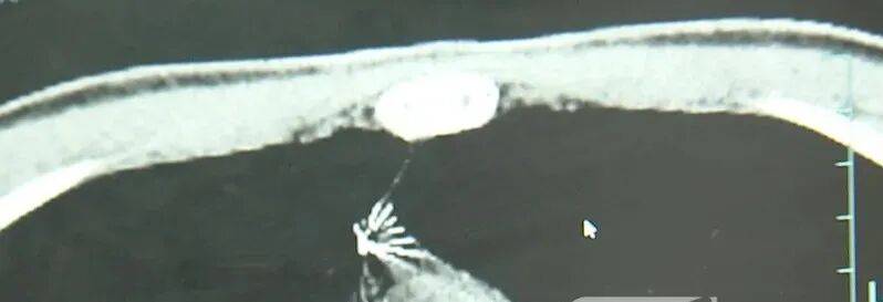 17岁小伙参军体检发现胸腔内有根5cm缝衣针<strong></p>
<p>互联网投资理财</strong>，父母回忆或是1岁时扎入，取出时已锈迹斑斑