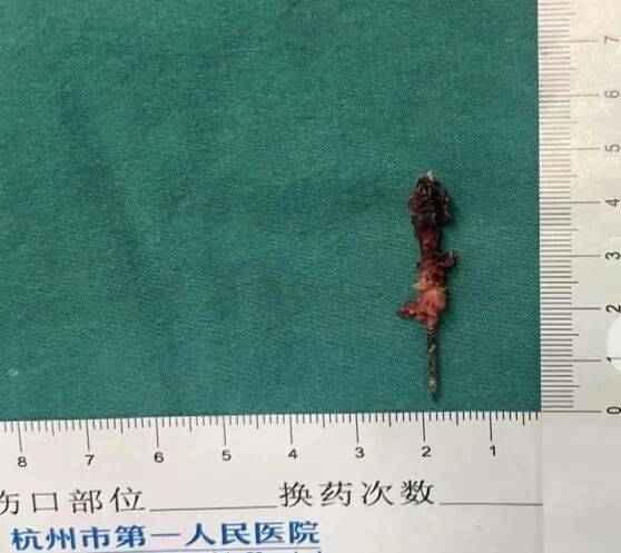 17岁小伙参军体检发现胸腔内有根5cm缝衣针<strong></p>
<p>互联网投资理财</strong>，父母回忆或是1岁时扎入，取出时已锈迹斑斑